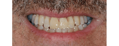 After Invisalign treatment